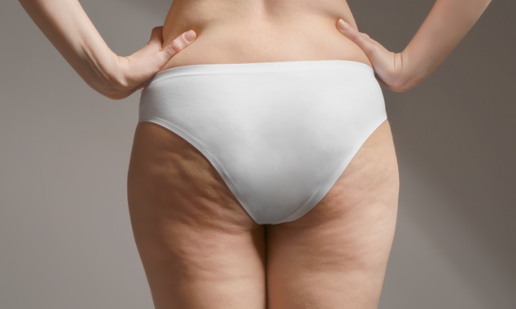 How Can I Get Rid of My Cellulite?